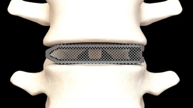 FDA 又批准5款3D打印脊椎植入物