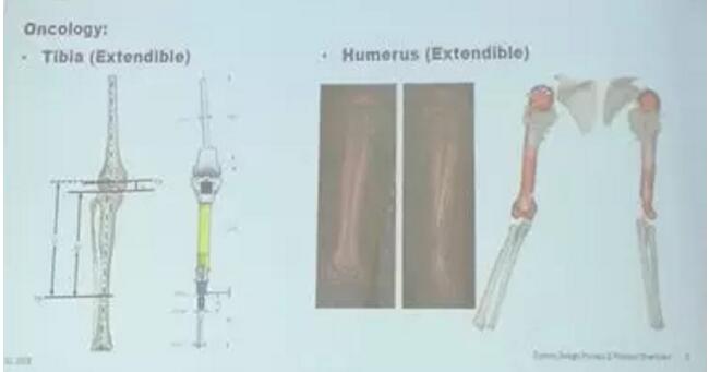 史赛克首席工程师解读个性化骨科植入物注册