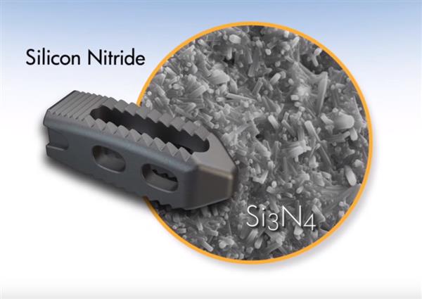 3D打印植入物的新成员：氮化硅陶瓷椎间融合器