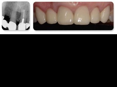 3D打印在牙科手术规划和手术中的作用