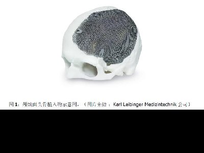 3D 金属打印技术促进颅颌面外科手术创新与发展