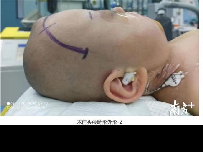 赞！运用3D打印，东莞医院为4岁患儿重新“造头”