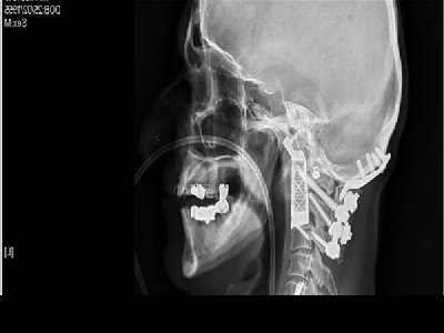 高难度脊椎切除手术中的3D打印植入物